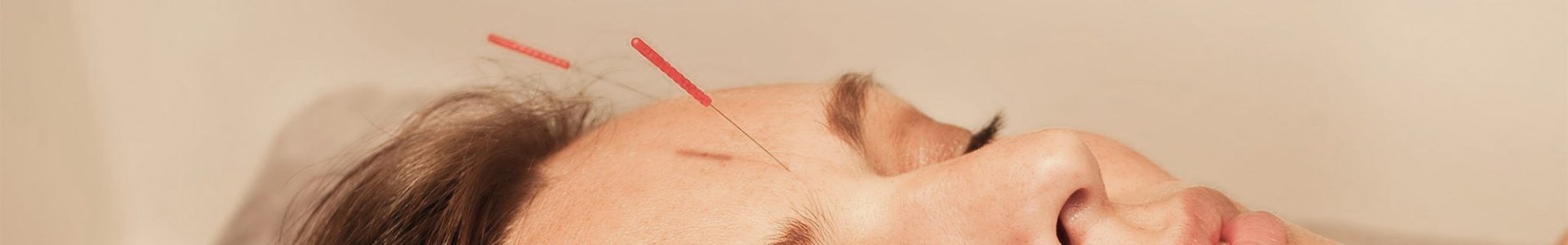 Kosmetisk akupunktur